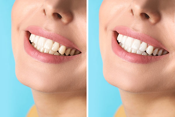 Cosmetic Dental Services With Natural Tooth Color