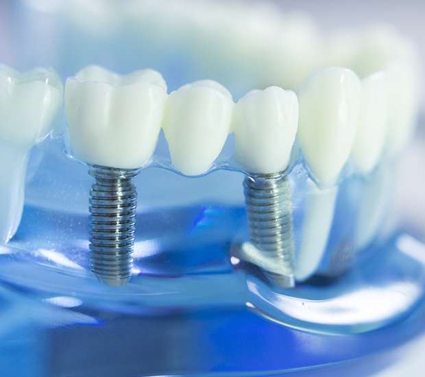 Santa Barbara Dental Implants